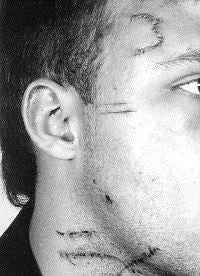 Un joven recibe 18 botellazos en el cuello y la cara, y le cortan una arteria