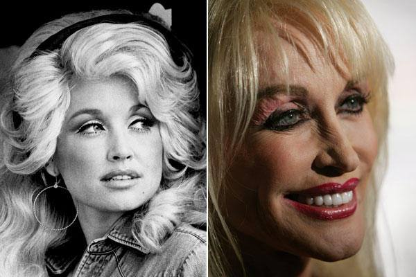 Dolly Parton, desde implante de senos hasta levantamiento de cejas y ojos, rinoplastia, lifting facial, botox y peeling químico.¿La que tuvo, retuvo?.