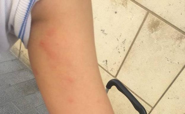 Simancas intensifica el tratamiento contra una plaga de procesionaria que ha afectado a varios jóvenes