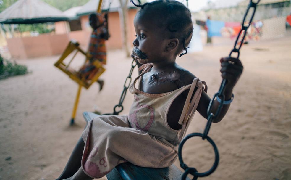 A sus cuatro años, Maryam es una superviviente del noma. Después de someterse a una operación facial reconstructiva, ha podido volver a jugar.