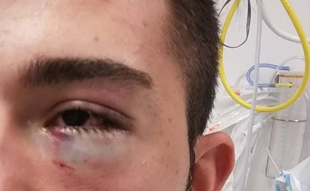 Estado en el que quedó el ojo del trabajador alcanzado por un objeto entre San Cristóbal y Trescasas.