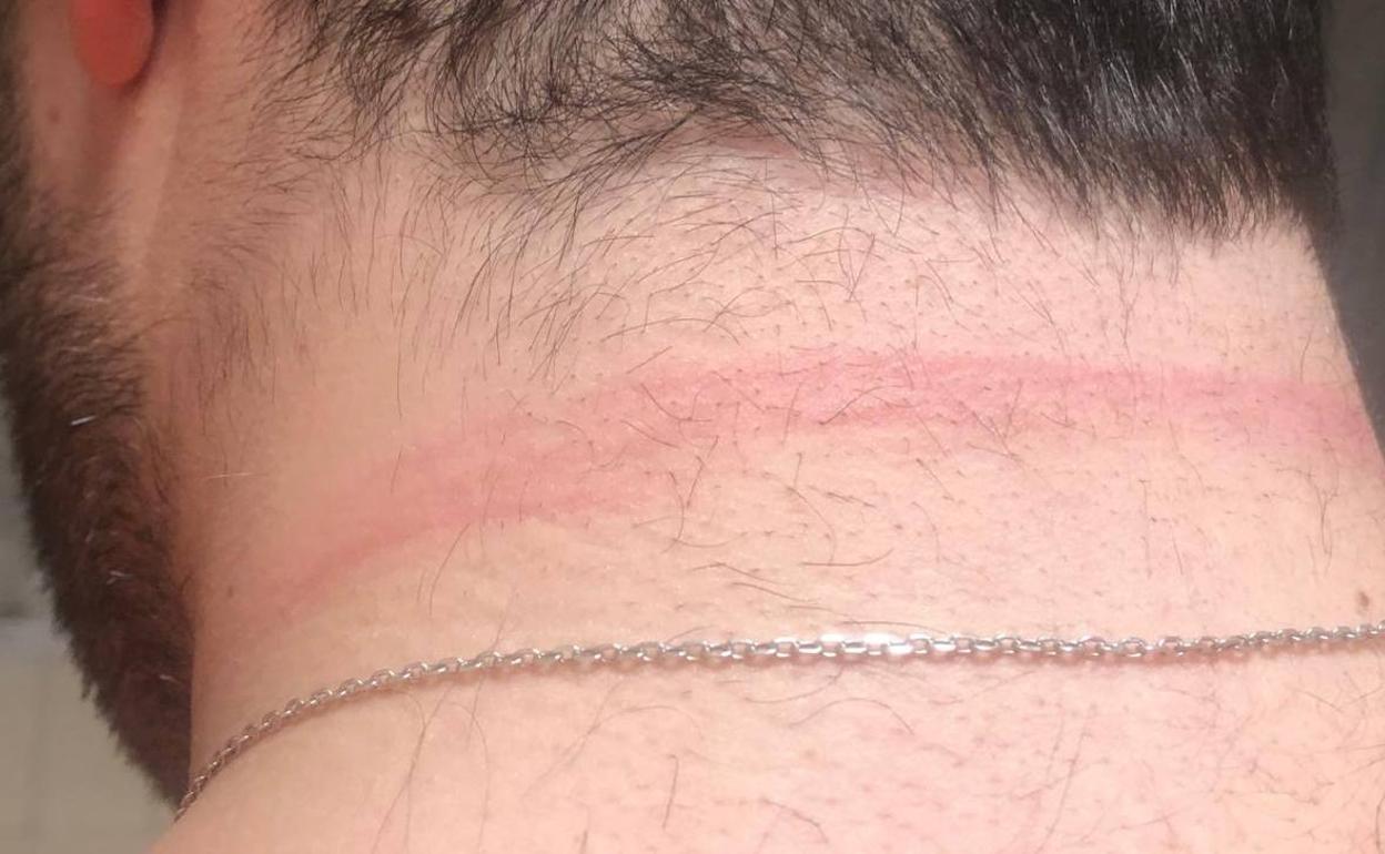 Marca en el cuello del fotógrafo del Zamora tras el incidente con un recogepelotas
