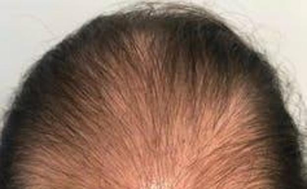 Alopecia adrogénica.