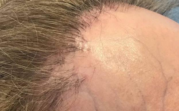 Alopecia frontal fibrosante.