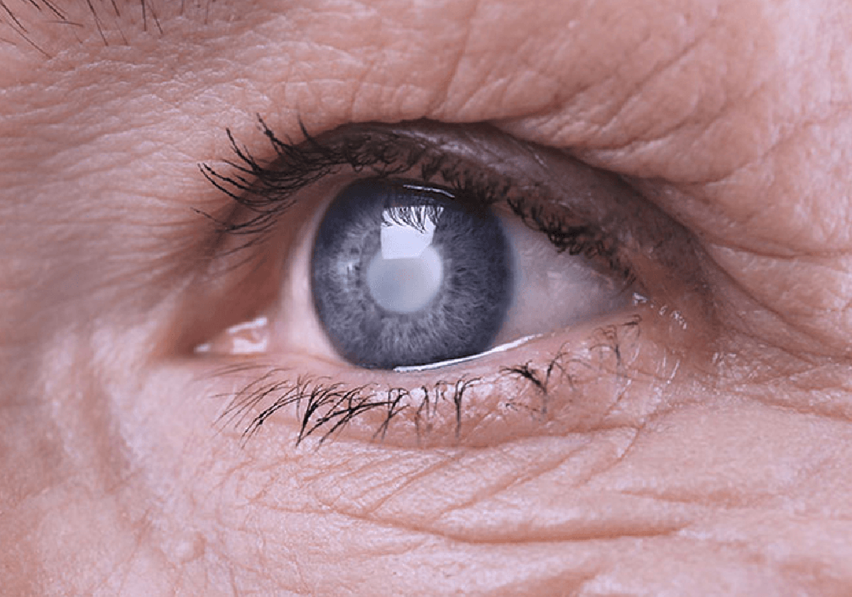 52.500 castellanos y leoneses padecen glaucoma y el 40% no lo sabe