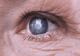 Enfermedad de glaucoma.