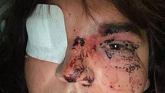 Una mujer trans denuncia una brutal agresión por ocho personas en La Bañeza