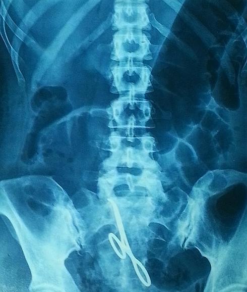 Radiografía en la que se observa la pinza en el interior del abdomen. 