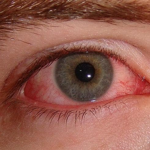 Lagrimeo, enrojecimiento ocular e hinchazón de los párpados, entre los síntomas clave. 