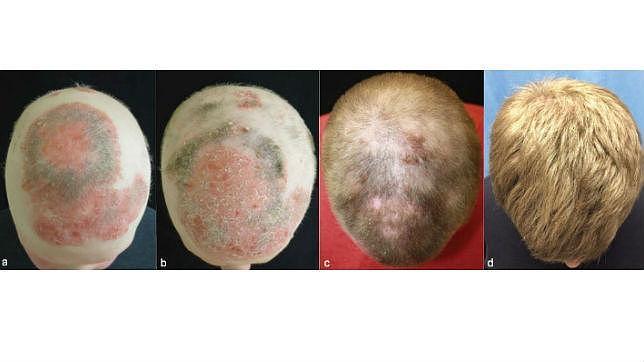 Así le creció durante ocho meses el pelo y mejoró la psoriasis del paciente. 