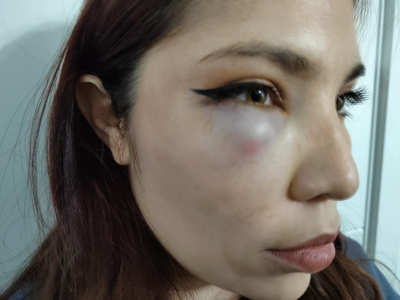 Lesiones sufridas por la joven de 19 años en su ojo derecho.