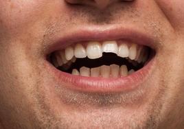 Preocupación por el aumento de fracturas dentales