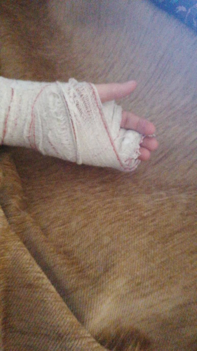 Mano con el yeso puesto 