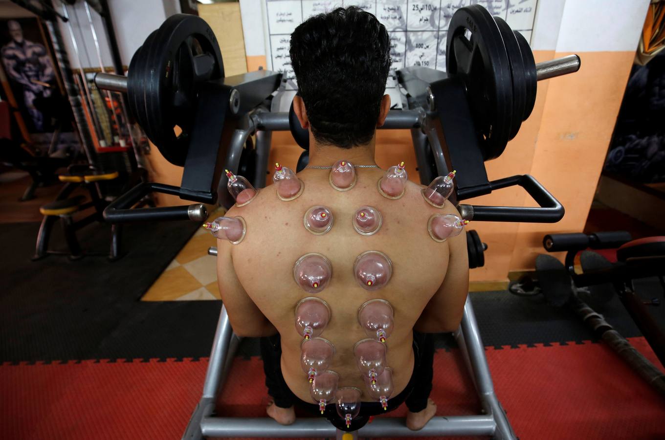 La terapia de ahuecamiento Hijama