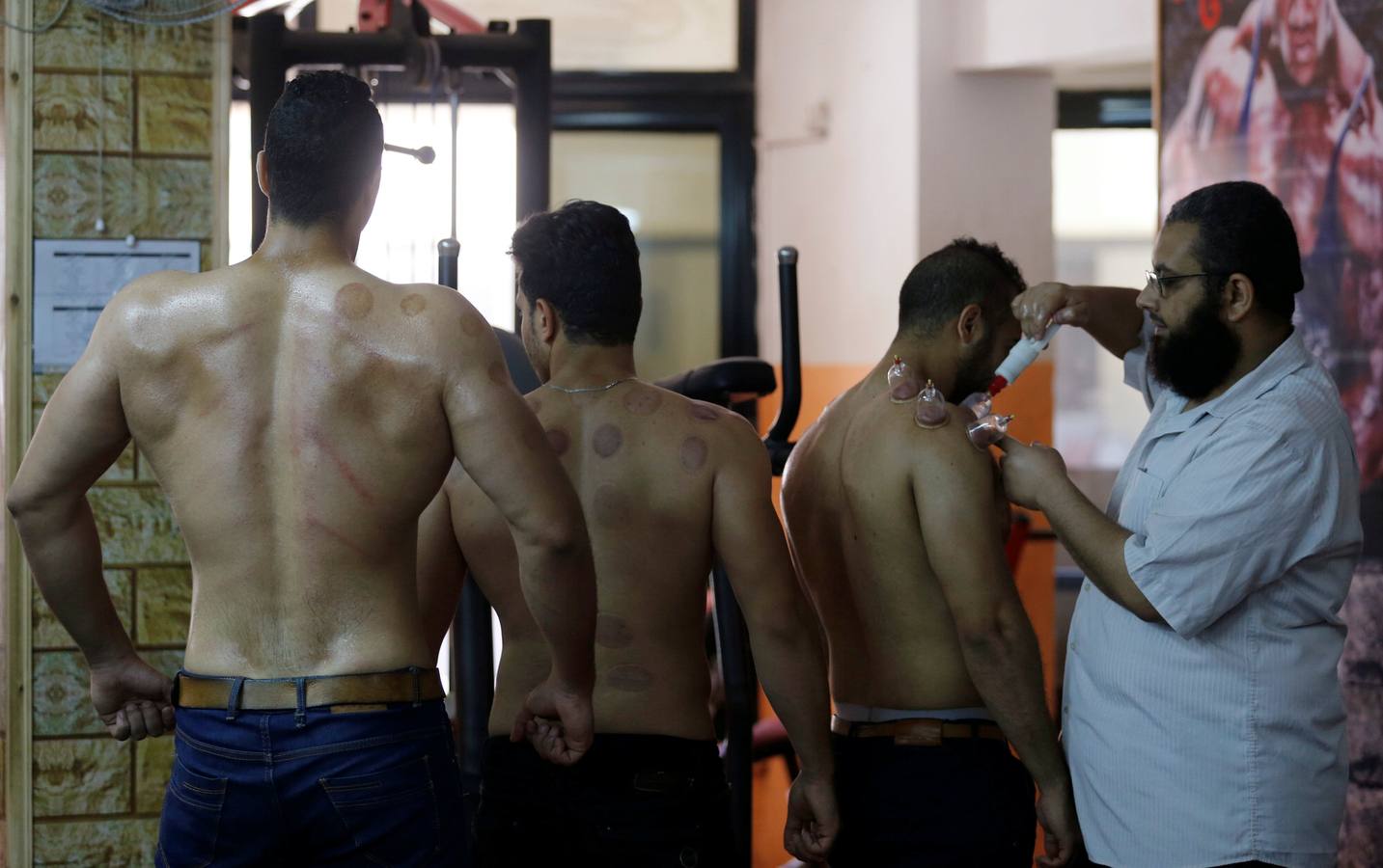 La terapia de ahuecamiento Hijama