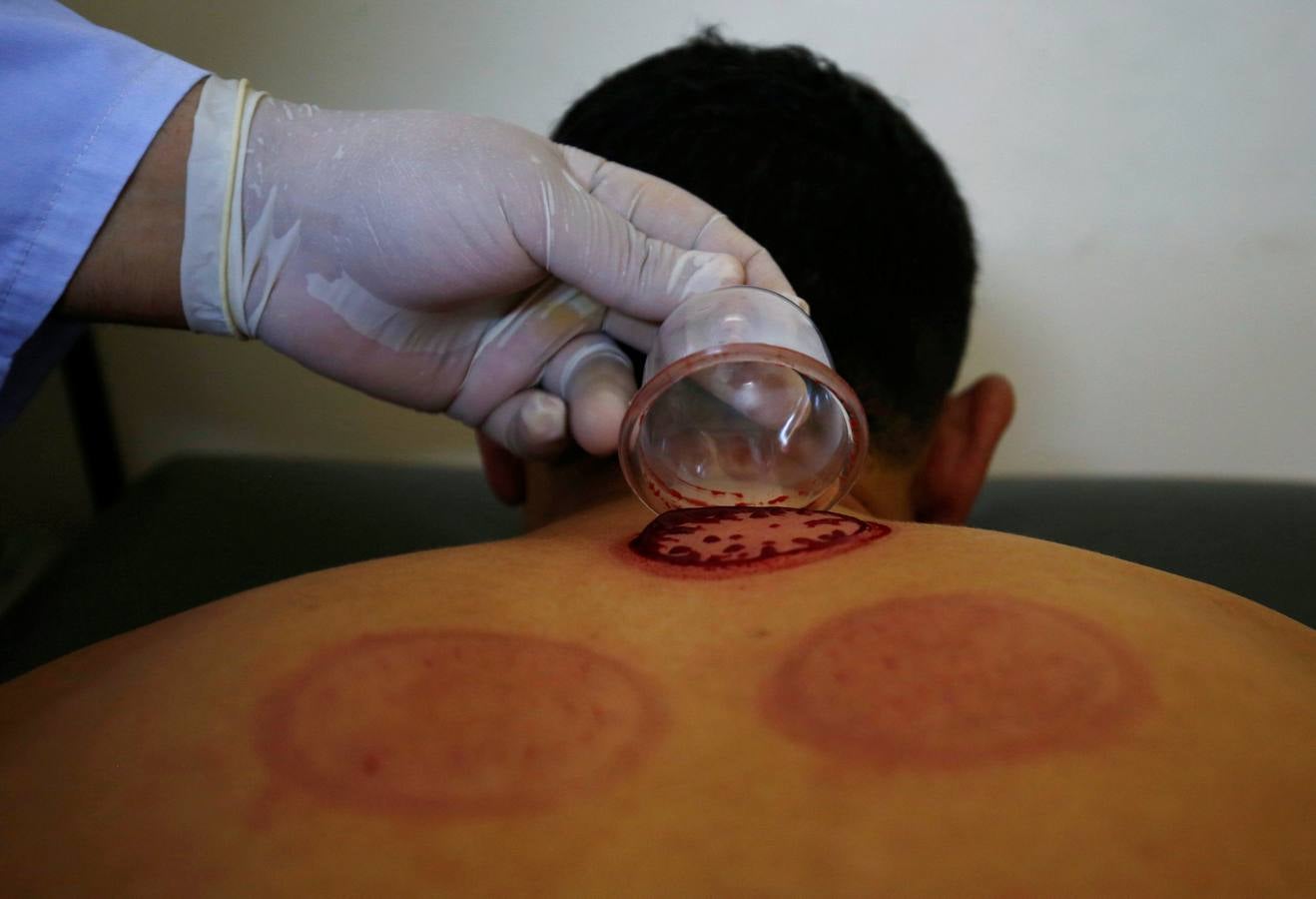 La terapia de ahuecamiento Hijama
