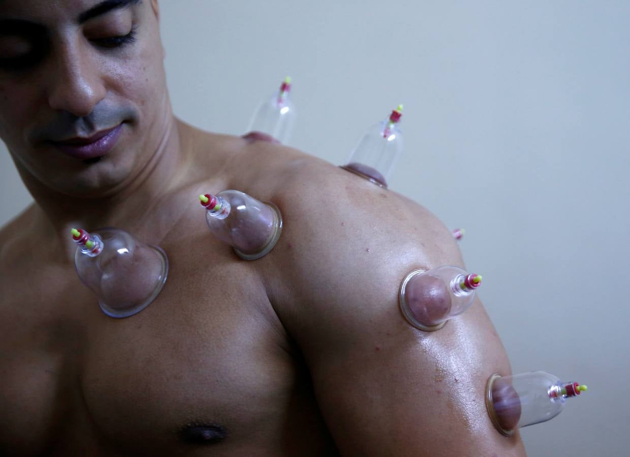 La terapia de ahuecamiento Hijama