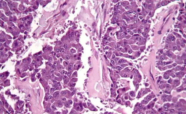 Carcinoma de células pancreáticas acinares.