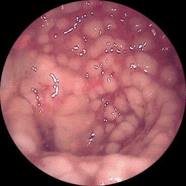 Endoscopía de colon con colitis pseudomembranosa.