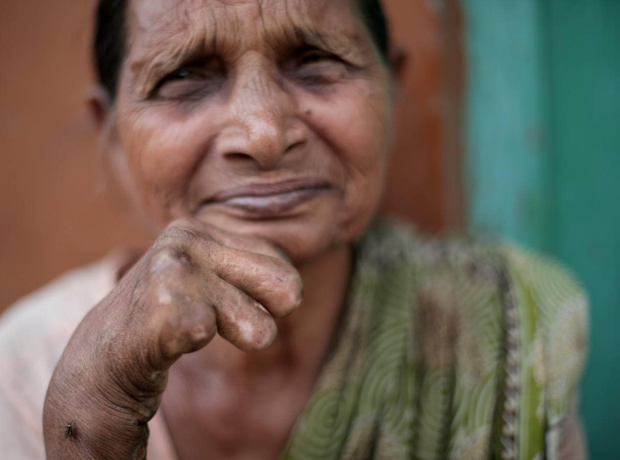 La lepra es una de las enfermedades infecciosas más antiguas que el hombre conoce. Según la Organización Mundial de la Salud (OMS), afecta principalmente la piel, los nervios, los ojos y el tracto respiratorio superior, pero la enfermedad es curable y el tratamiento en sus primeras etapas puede prevenir la discapacidad. Fuera de la ciudad de Titagarh, en el estado indio de Bengala Occidental, la Madre Teresa estableció en 1958 el Centro de Lepra Gandhiji Prem Nivas. Dirigido por sus Misioneras de la Caridad, el centro fue construido para una comunidad existente de personas con lepra. Ahora, más de 1000 personas, los afectados y sus familias, viven y trabajan en las instalaciones. Los residentes que se han recuperado de la enfermedad trabajan como tejedores en el centro. Producen los saris azules y blancos que usan las monjas de la Caridad. Los niños de los pacientes reciben educación gratuita en el centro, que también ofrece comida gratis, atención médica básica y tratamiento psicológico a sus residentes. La instalación se lleva a cabo con la ayuda de donaciones y el apoyo de la OMS, que en abril de 2016 lanzó la Estrategia Global de Lepra 2016-2020, dirigida a la eliminación mundial de la enfermedad. Gandhiji Prem Nivas participa en el programa de la OMS junto con otros hospitales en la India. Ofrece tratamientos recomendados por la OMS no solo para pacientes que residen en el centro, sino también para otras personas afectadas por la lepra que necesitan atención médica. 