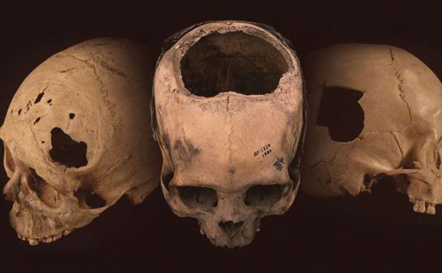 Trepanaciones incas. 