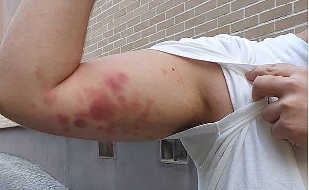El arrestado muestra las lesiones que tenía en su brazo.