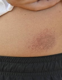 Imagen secundaria 2 - Golpes y heridas para poder jugar a vóley-playa