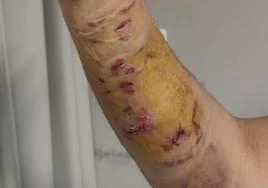 Heridas que tiene Antonio Fernández en el cuerpo a causa de las mordeduras del perro.