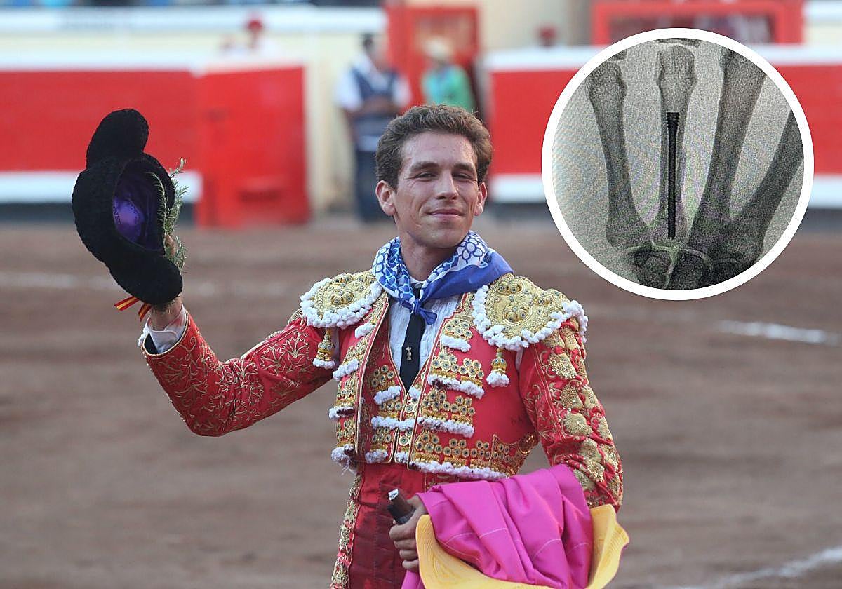 Ginés Marín, junto a la radiografía tras su operación en el cuarto metacarpiano.