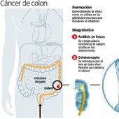 Los extremeños, entre los que menos acuden al cribado de cáncer de colon