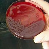 ¿Qué es el ántrax o carbunco?