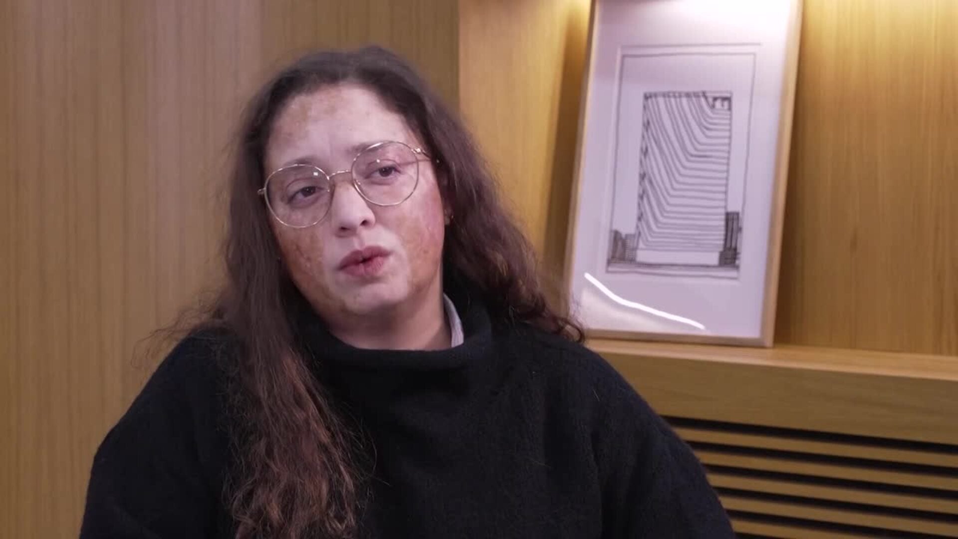 La enfermedad de injerto contra receptor crónica es la "cara B" de los trasplantes de médula