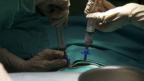 Los médicos inyectan células madre en la arteria de un paciente. 