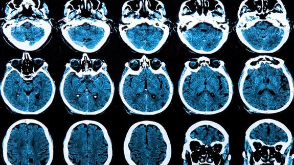 Imagen por resonancia magnética de un cerebro humano.