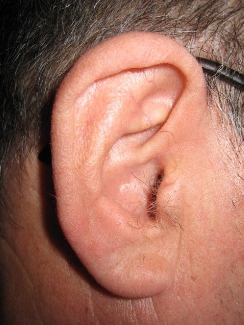 Oreja de una persona con PDL (izda) y sin PDL (dcha). 