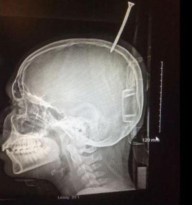 Un adolescente se clava un tornillo en el cráneo al caerle una madera en la cabeza
