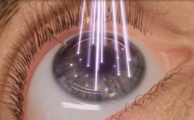 7 venajes de la cirugía láser ocular: ¿por qué debes hacértela?