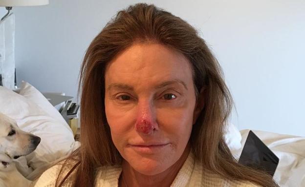 Caitlyn Jenner publica una impactante imagen con la que anuncia que padece cáncer de piel