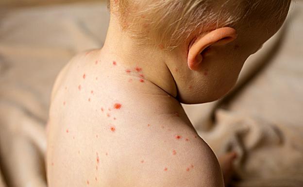 Aviso de los pediatras: «vacunen a los adultos de sarampión por los nuevos brotes»