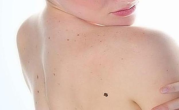 ¿Qué personas tienen más probabilidades de sufrir cáncer de piel?