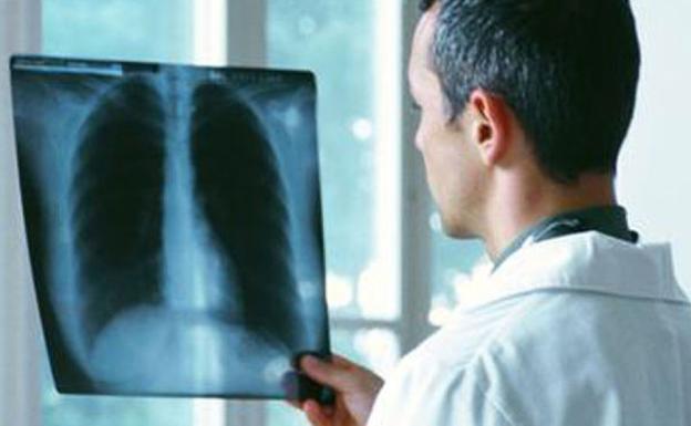 Salud | Un nuevo sistema permite el diagnóstico precoz del cáncer de pulmón