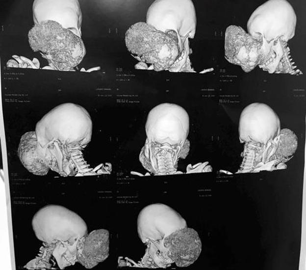 Imagen de la evolución del tumor antes de la operación. 