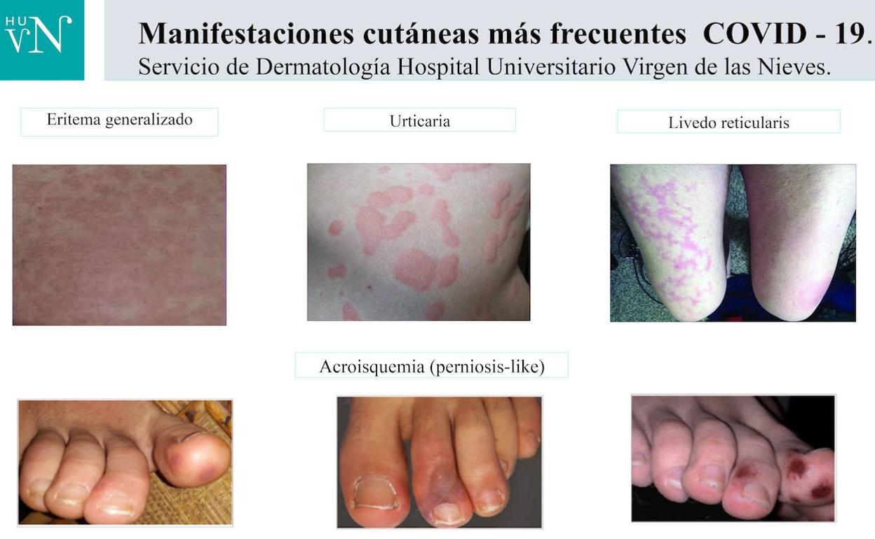 Resumen de las manifestaciones cutáneas más comunes analizadas por los dermatólogos del hospital granadino. 