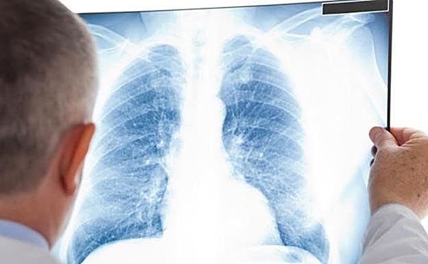 Un estudio desvela el daño a largo plazo que el coronavirus hace a los pulmones