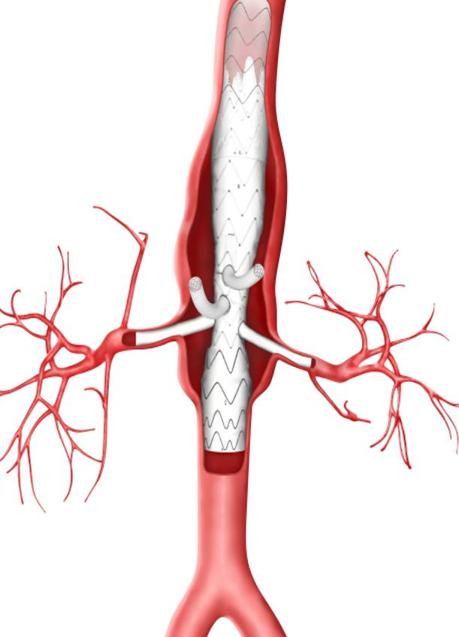 Imagen - Recreación digital del implante en la aorta. 