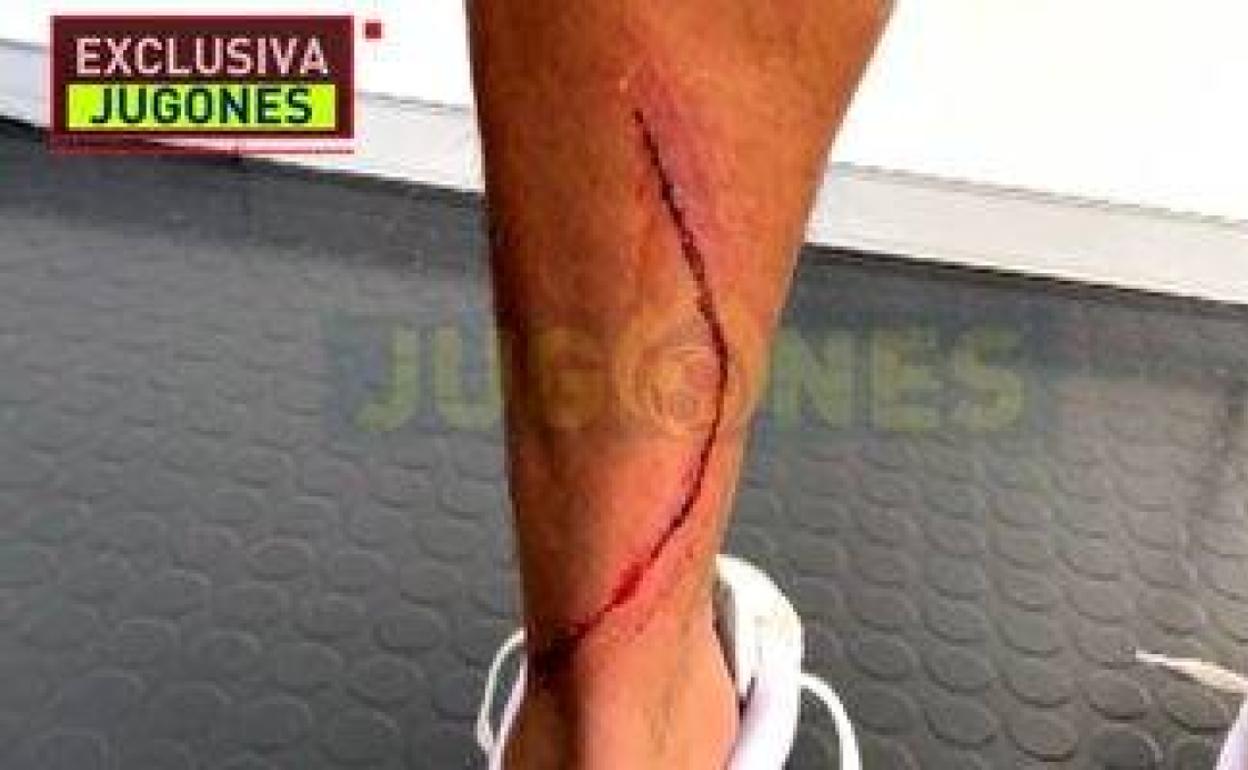 Estado de la pierna de Marvin tras la entrada de Machís. 