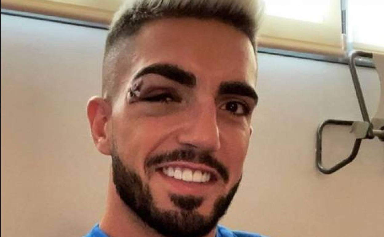 Así lucía el párpado de Monchu Rodríguez el pasado domingo, cuando lo mostró en redes sociales. 