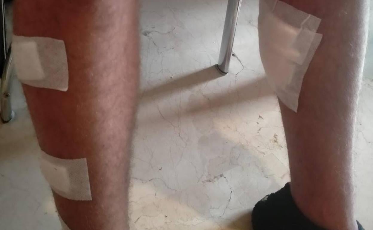 Así tiene las piernas uno de los adolescentes tras el altercado.