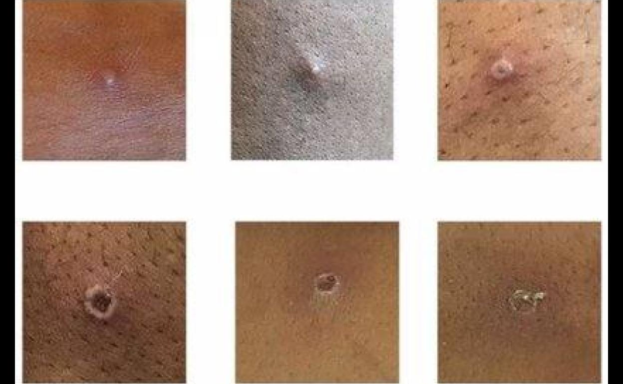 Archivo. Viruela del mono.