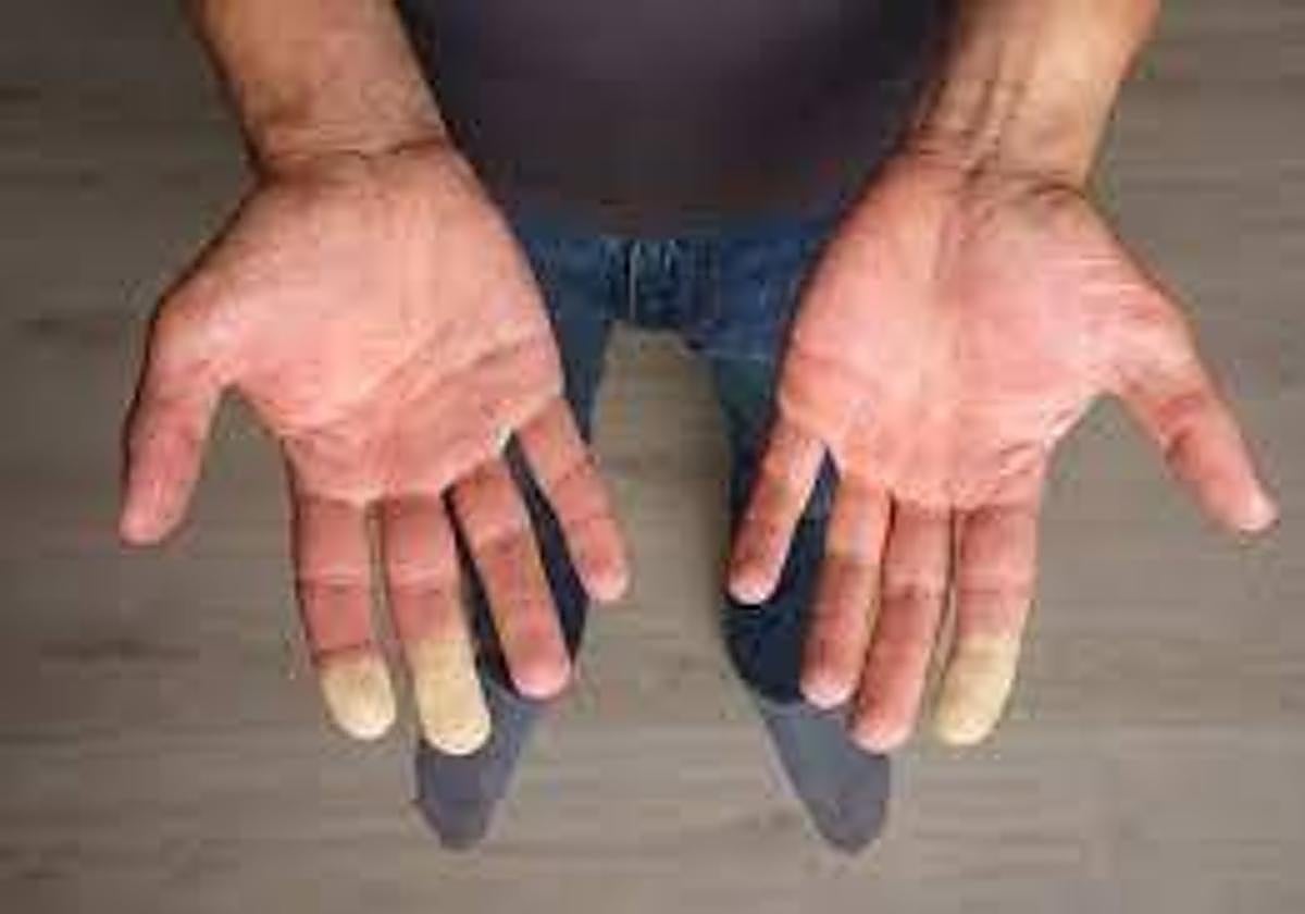 Síndrome de Raynaud